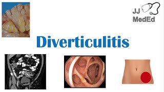 Diverticulitis Risk Factors ex Low Fiber Diets Symptoms Diagnosis Treatment and Complications [upl. by Verner790]