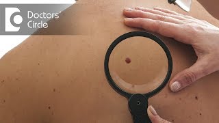 Difference between Melanoma and other skin pigmentations  Dr Rajdeep Mysore [upl. by Shell]