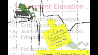 Teaching 12 Lead EKG STEMI or early repol [upl. by Tanny]