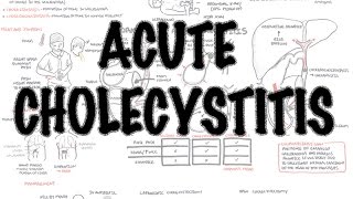 Acute Cholecystitis  Overview signs and symptoms pathophysiology treatment [upl. by Vaenfila]