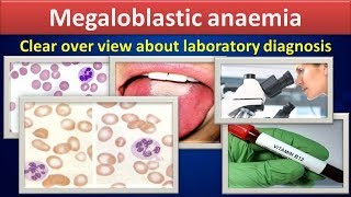 Megaloblastic anemiaClear over view about laboratory diagnosis [upl. by Say]