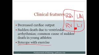 8 6 Cardiomyopathy 8 7 Cardiac Tumors [upl. by Ahsilaf]