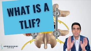 How I perform a TLIF and what to expect after [upl. by Wendalyn800]