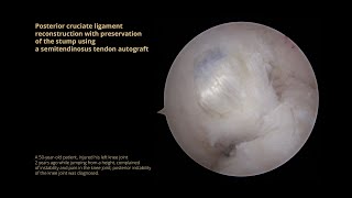 Posterior cruciate ligament reconstruction with preservation of the stump using a semitendinosus ten [upl. by Barstow558]