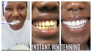 How I whitened my yellow teeth in 2 Minutes  LIVE DEMO HOME REMEDY [upl. by Kilroy]