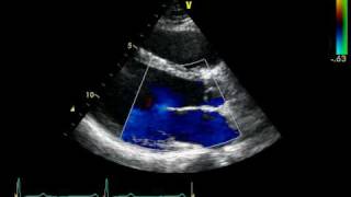 PARASTERNAL VIEW LAX  COLOR  NORMAL STUDY [upl. by Neeroc435]