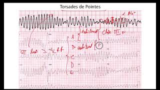 Torsades de Pointes EKG [upl. by Eibber384]