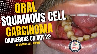 ORAL SQUAMOUS CELL CARCINOMA  HOW DANGEROUS OR LEATHAL IS IT  AN ORIGINAL CASE REPORT PART 1 [upl. by Nertie]