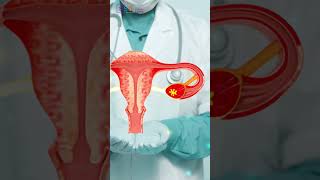 How Advanced is Stage 3 Ovarian Cancer Find Out Now  Dr Praveen Kammar Mumbai [upl. by Inwat]