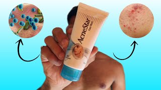 Acnestar face wash review  kya acnestar soap se behtar hai [upl. by Llevron907]