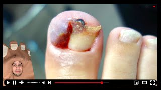 SUPER BAD OVERGROWN TOENAIL toebroclip [upl. by Kala]