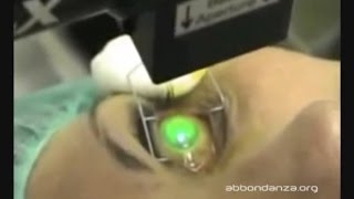 Corneal Collagen Crosslinking for keratoconus  Dr Marco Abbondanza [upl. by Yemerej980]