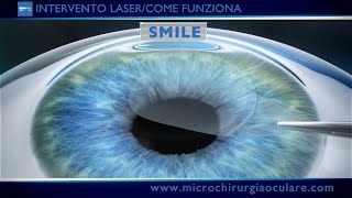 Intervento Laser Occhi Come Funziona [upl. by Newmark]