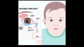 ជំងឺស្ទះរន្ធទឹកភ្នែក NasoLacrimal Duct ObstructionDacryostenosis [upl. by Borrell302]