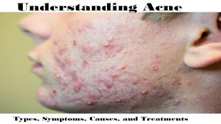 Understanding Acne Types Symptoms Causes and Treatments [upl. by Adihaj]