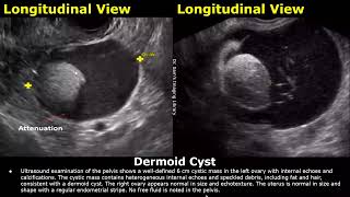 Ovary Ultrasound Reporting  Ovarian Diseases Scan Reports  How To Write USG Report  Pelvic USG [upl. by Schriever]