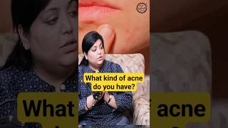 Hormonal Acne Treatment acne skincare dermatologist shorts [upl. by Bethena882]