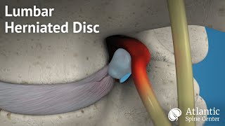 Lumbar Herniated Disc Overview [upl. by Naivat187]