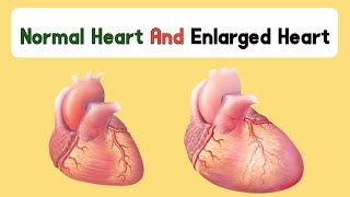 Enlarged Heart Treatment  Enlarged Heart Symptoms  Enlarged Heart enlarge hearttreatment [upl. by Ojytteb]