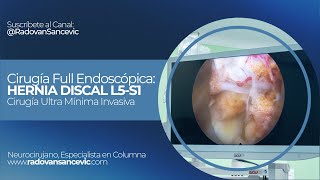 Cirugía Full Endoscópica HERNIA DISCAL L5S1 [upl. by Hamirak]