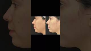 Amazing Result SylfirmX RF Microneedling Treatment  Ageless MD [upl. by Bree]