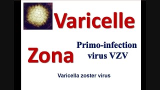 La Varicelle et le zona Chez ladulte les symptomes de la maladie virale des lesions cutanées [upl. by Amilas]