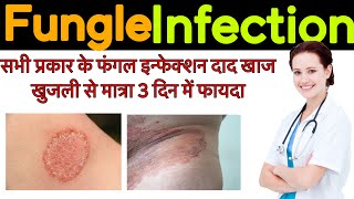 Fungle infection  Fungle infection treatment symptoms  precaution [upl. by Bound]