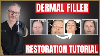 Dermal Filler Demonstration amp Tutorial  Liquid Rhinoplasty  Nasolabial Folds [upl. by Anayia577]