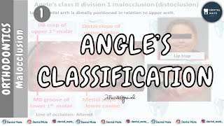 Angles Classification of Malocclusion  Dr Paridhi Agrawal [upl. by Notnroht]