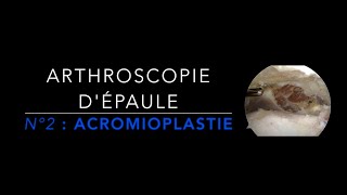 EPAULE N°2  Acromioplastie [upl. by Damour]