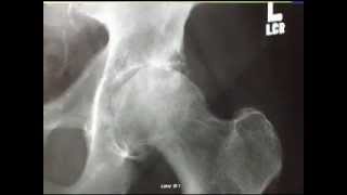 Diagnosing an Arthritic Hip Joint [upl. by Luciano]