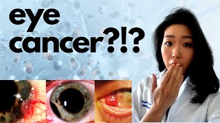 Eye Cancer  Five Important Eye Cancers You NEED To Know About [upl. by Naedan]