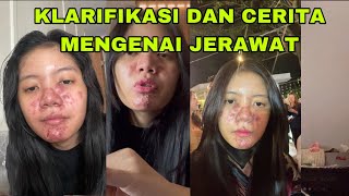 CERITA FULL AKU MENGENAI JERAWAT ANEH INI [upl. by Asiar]