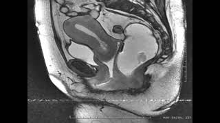 Laparoscopic – Pelvic Organ Prolapse suspension L POPs 2 [upl. by Pelagias]