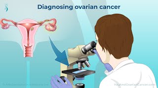 Diagnosing Ovarian Cancer [upl. by Akerboom]