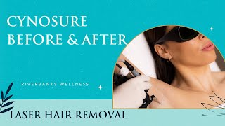 Cynosure Laser Hair Removal Before amp After  What You Need to Know [upl. by Dirk901]