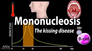 Infectious Mononucleosis Mono  the Kissing Disease Animation [upl. by Androw]