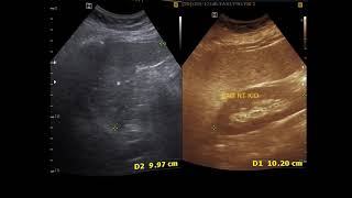 Ultrasound cases 361 of 2000  Utricle Cyst Splenic Cyst Hypoechoic nodule Breast Duct ectasia [upl. by Finer]