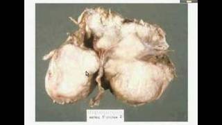 HistopathologyBrain Meningioma [upl. by Neelak440]