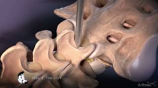 Interlaminar Approach for Discectomy Procedures [upl. by Ennasus]