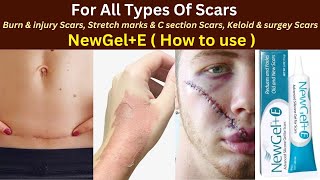 Newgele how to use  newgel for acne burn keloid surgery scars  Scar removal treatment [upl. by Archle]