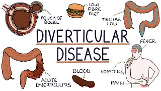 Understanding Diverticulosis and Diverticulitis [upl. by Yelhsa423]