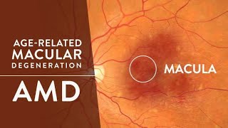 Age Related Macular Degeneration  Anti  VEGF  ARMD Patient Education amp Explanation [upl. by Shurwood]