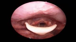 Posterior laryngitis I Fiberoptic examination of larynx [upl. by Aleron]