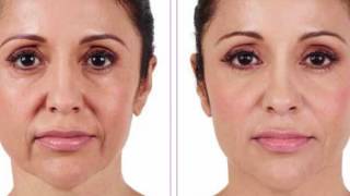 Botox vs Juvederm [upl. by Cassiani645]