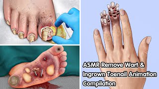 ASMR Remove Wart amp Ingrown Toenail Animation Compilation  Deep Cleaning Animation [upl. by Oneil]