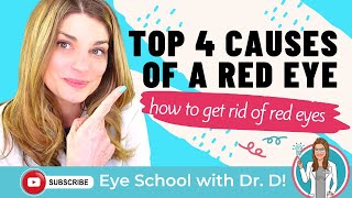 How To Get Rid Of Red Eyes  Top 4 Causes Of A Red Eye  An Optometrist Dishes all the Dirt [upl. by Ibrek]