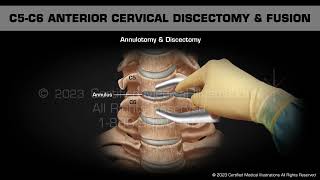 C5C6 Anterior Cervical Discectomy amp Fusion [upl. by Moses537]