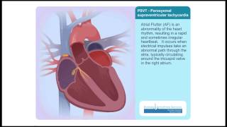 PSVT Paroxysmal Supraventricular Tachycardia Animation Video [upl. by Sielen585]