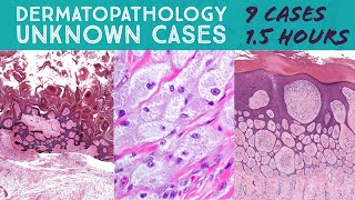 Dermatopathology Unknown Cases for University of New Mexico UNM Dermatology Residents Board Review [upl. by Adriel]